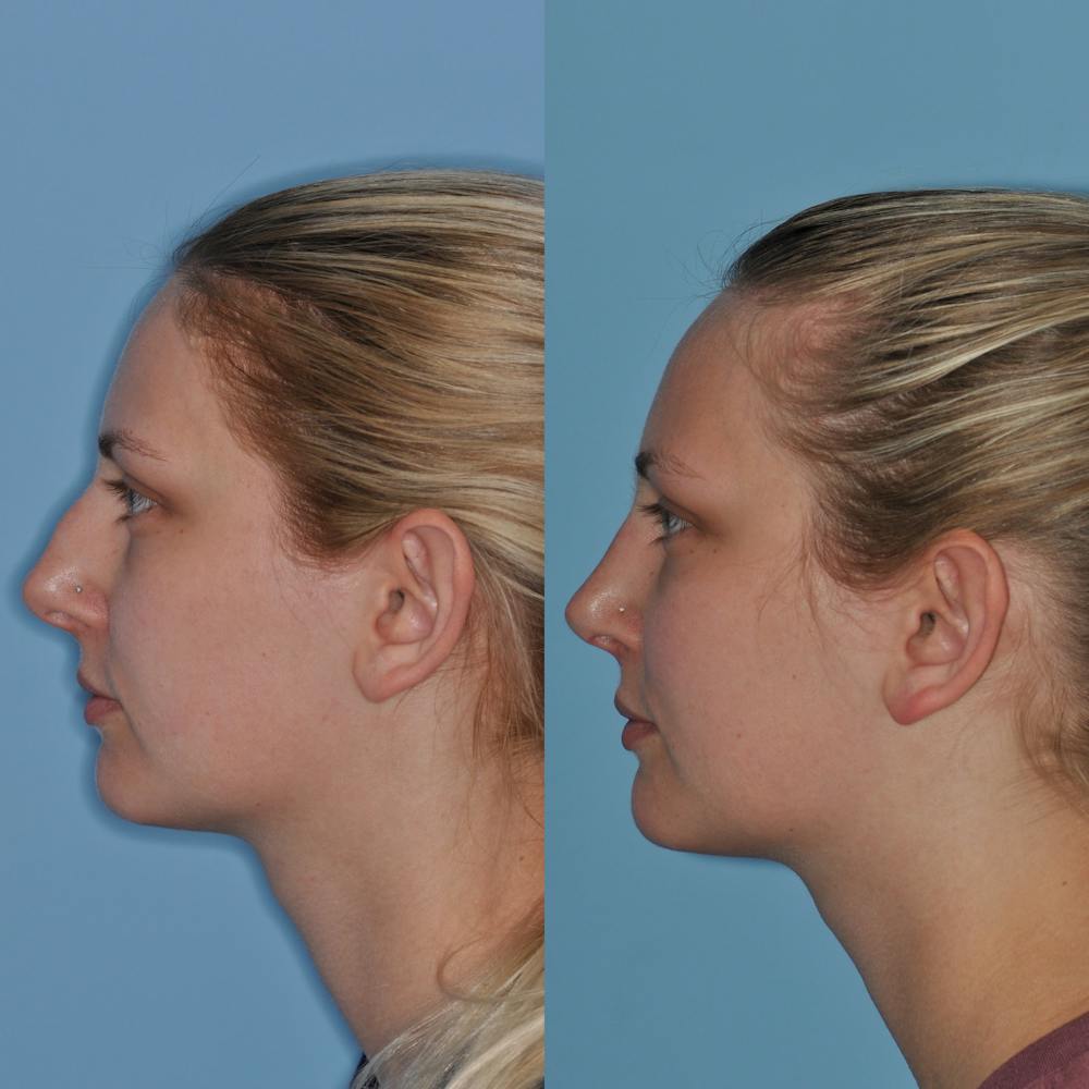 Rhinoplasty Before & After Gallery - Patient 59075296 - Image 5