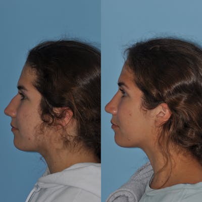 Rhinoplasty Before & After Gallery - Patient 59075297 - Image 2