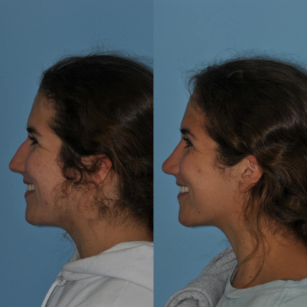Rhinoplasty Before & After Gallery - Patient 59075297 - Image 3