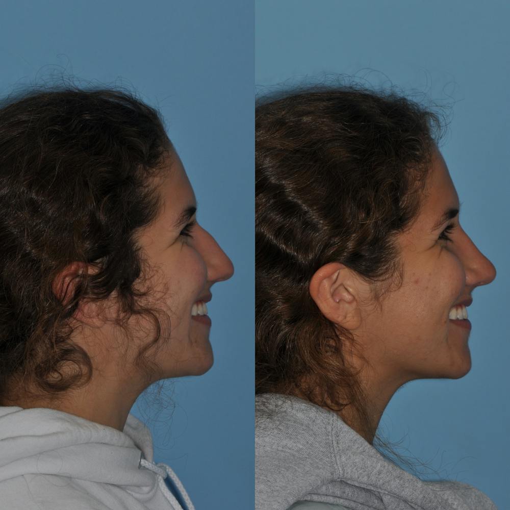 Rhinoplasty Before & After Gallery - Patient 59075297 - Image 4