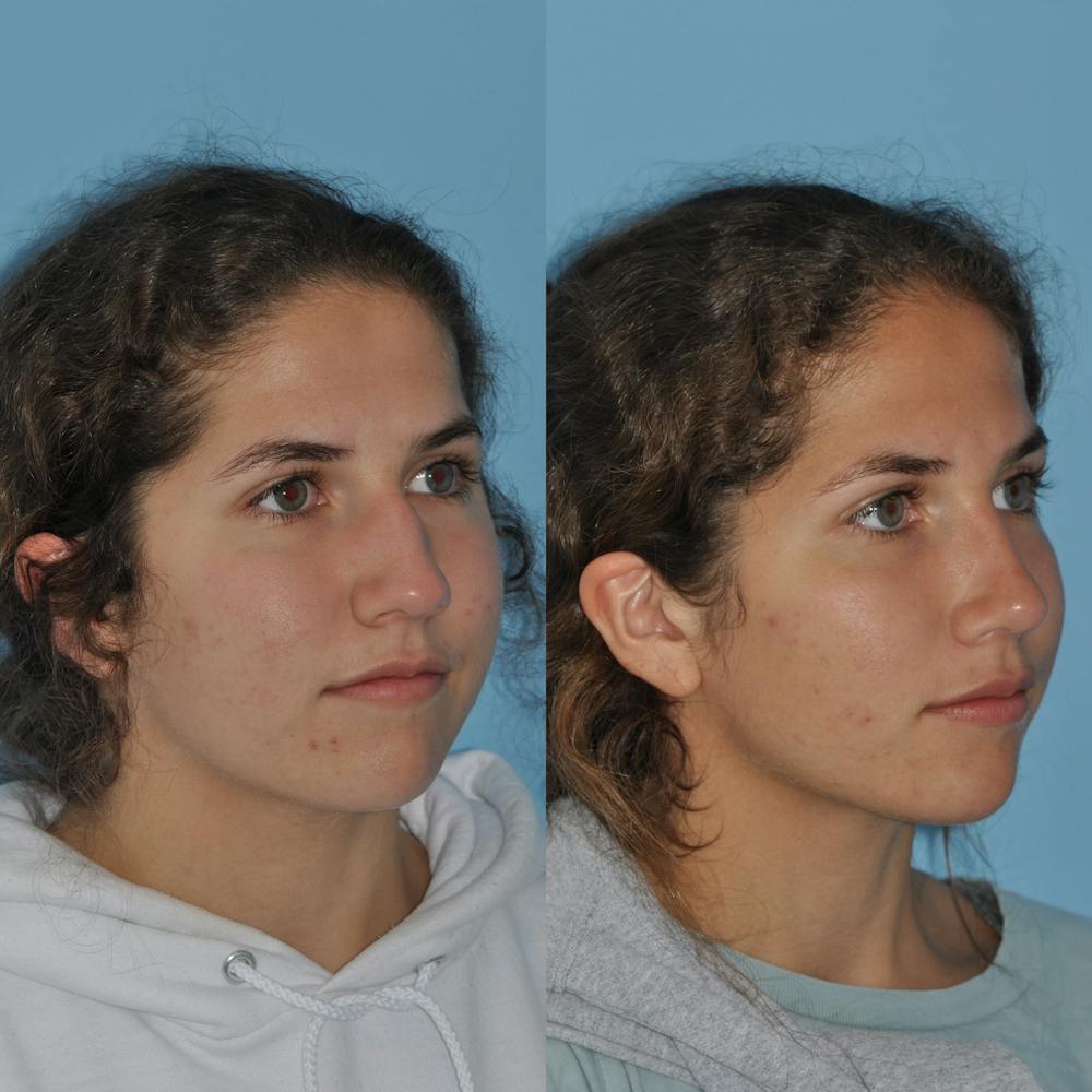 Rhinoplasty Before & After Gallery - Patient 59075297 - Image 5