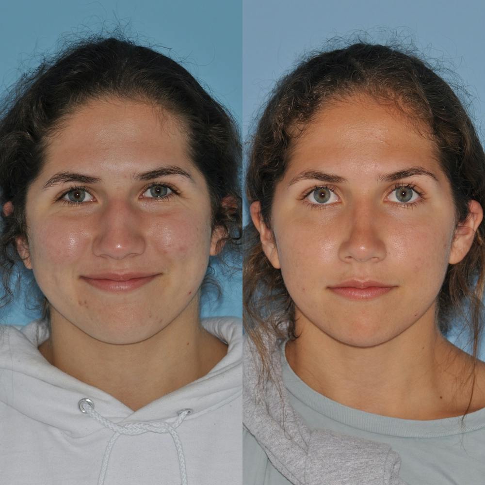 Rhinoplasty Before & After Gallery - Patient 59075297 - Image 7
