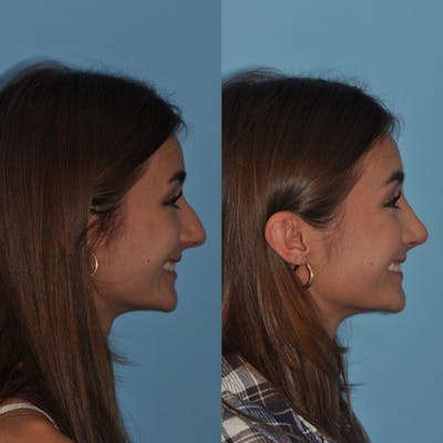 Rhinoplasty Before & After Gallery - Patient 59075298 - Image 1