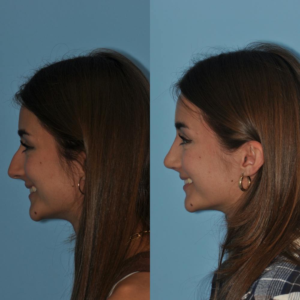 Rhinoplasty Before & After Gallery - Patient 59075298 - Image 7