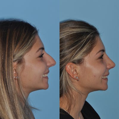 Rhinoplasty Before & After Gallery - Patient 59075299 - Image 6