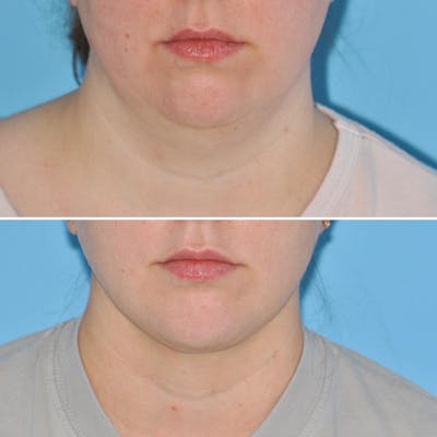 THERMItight Before & After Gallery - Patient 176984912 - Image 2