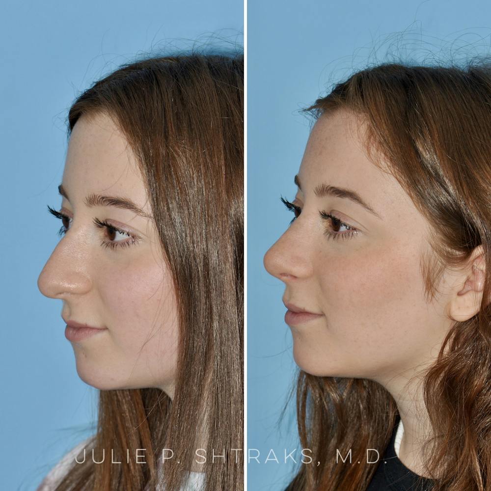 Rhinoplasty Before & After Gallery - Patient 144687083 - Image 4