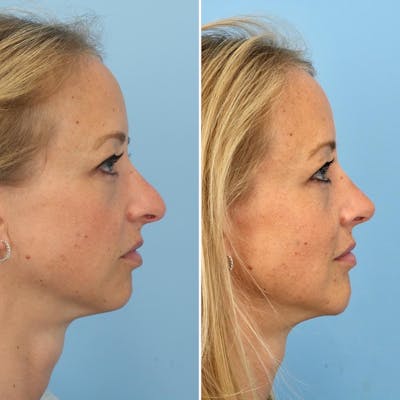 Rhinoplasty Before & After Gallery - Patient 144687084 - Image 1