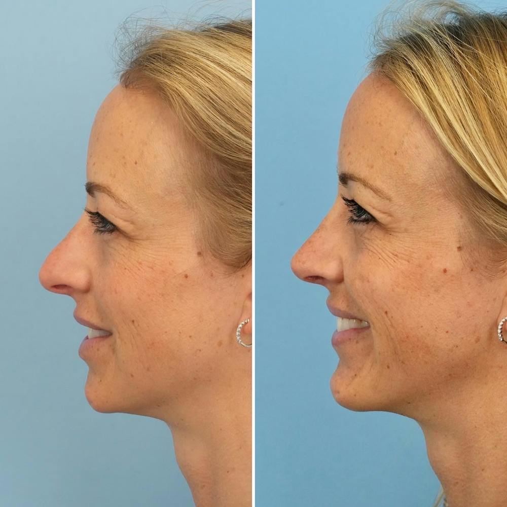 Rhinoplasty Before & After Gallery - Patient 144687084 - Image 3