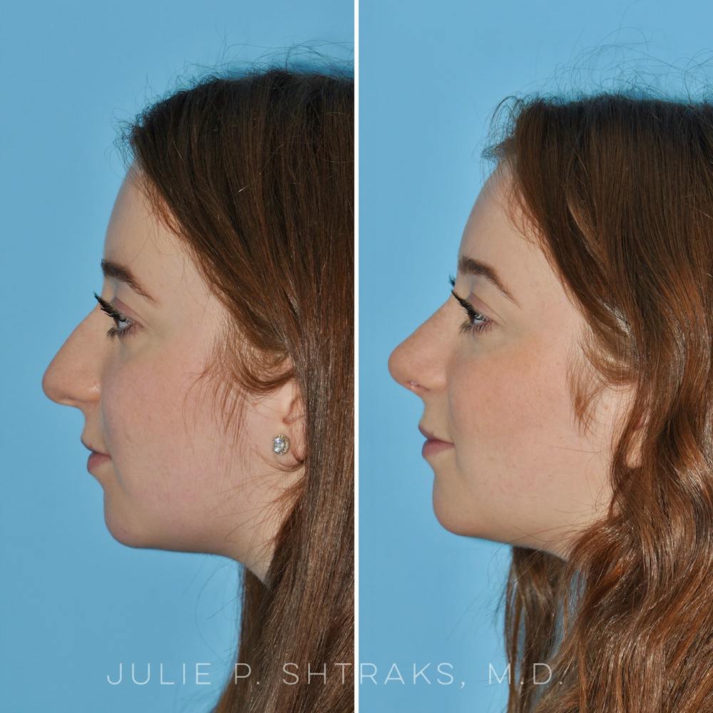 Rhinoplasty Before & After Gallery - Patient 144687083 - Image 5