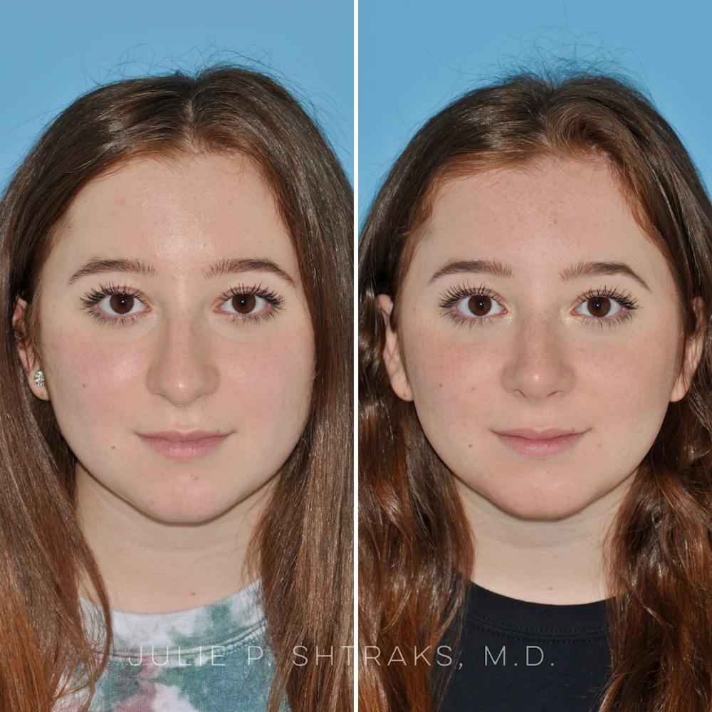 Rhinoplasty Before & After Gallery - Patient 144687083 - Image 3