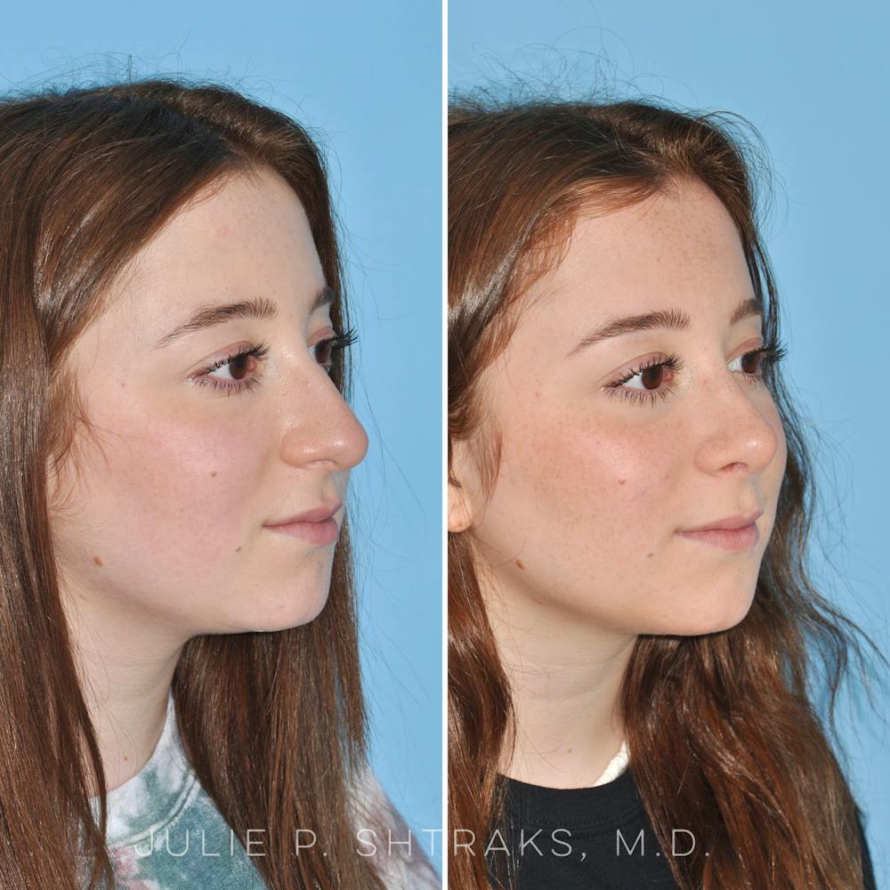 Rhinoplasty Before & After Gallery - Patient 144687083 - Image 2