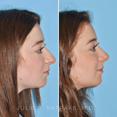 Rhinoplasty Before & After Gallery - Patient 144687083 - Image 1