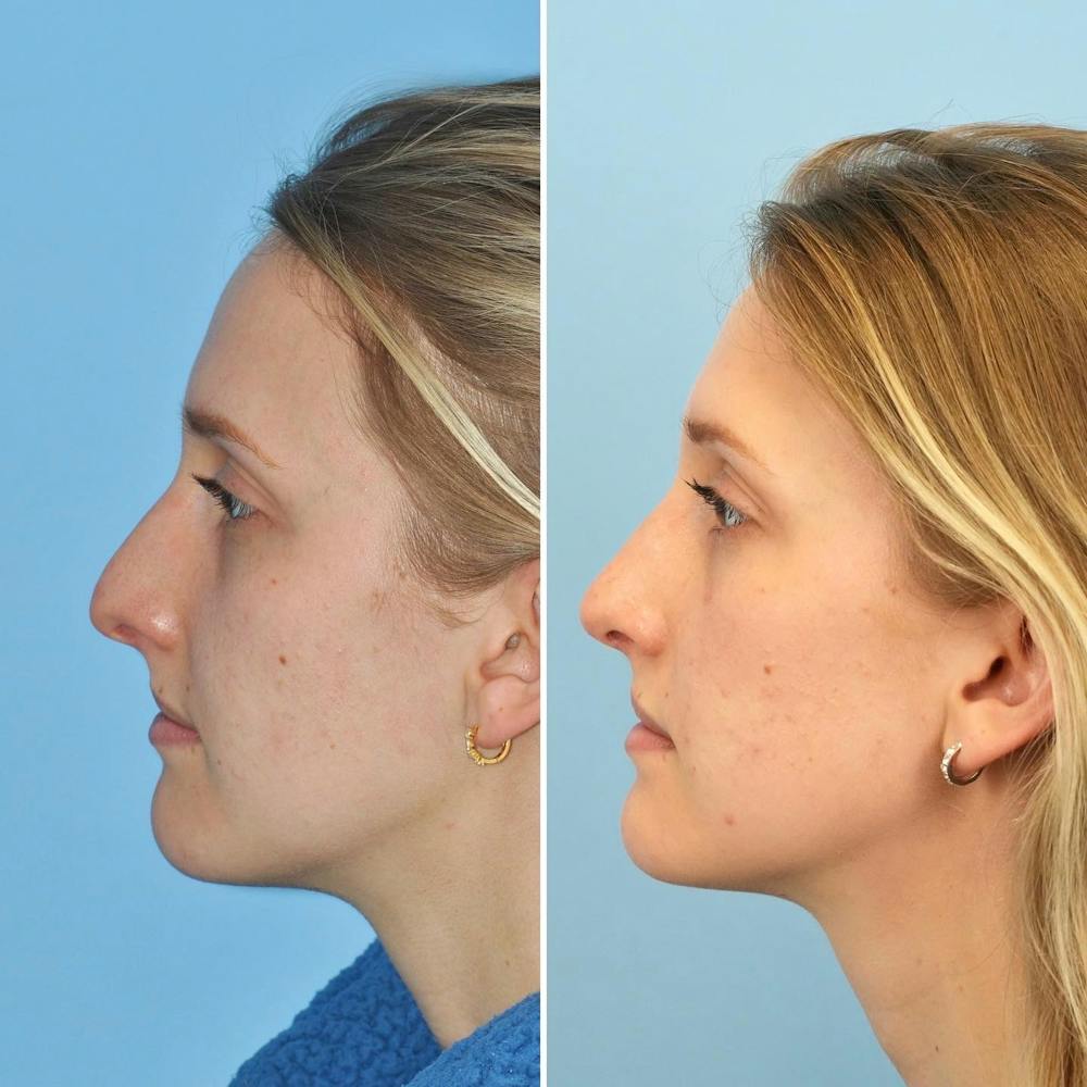 Rhinoplasty Before & After Gallery - Patient 144687095 - Image 2