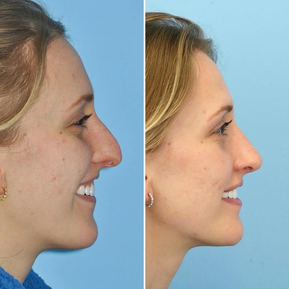 Rhinoplasty Before & After Gallery - Patient 144687095 - Image 3