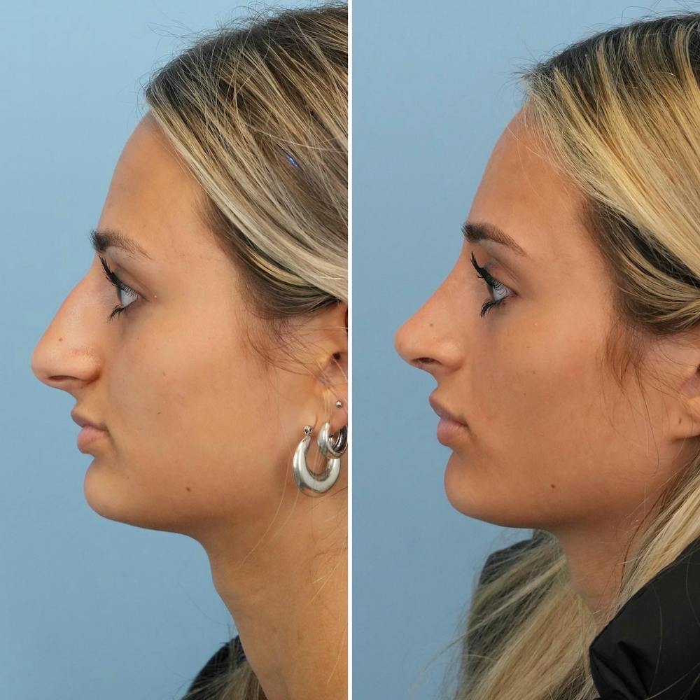 Rhinoplasty Before & After Gallery - Patient 144687100 - Image 5