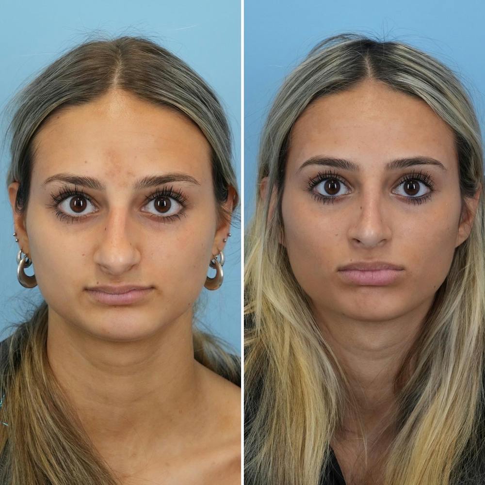 Rhinoplasty Before & After Gallery - Patient 144687100 - Image 3