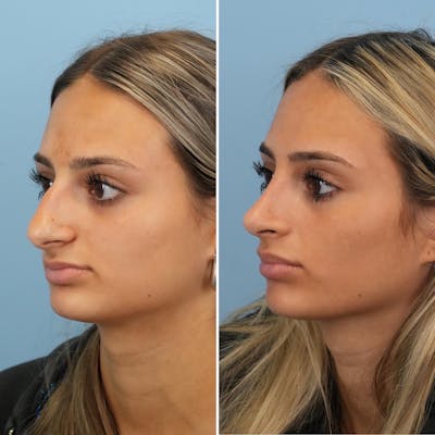 Rhinoplasty Before & After Gallery - Patient 144687100 - Image 4
