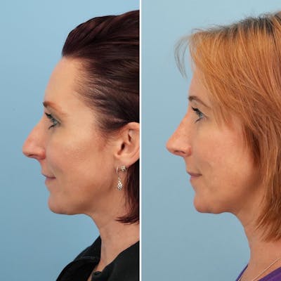 Rhinoplasty Before & After Gallery - Patient 144687101 - Image 2