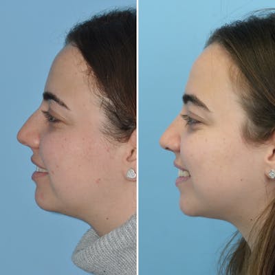Rhinoplasty Before & After Gallery - Patient 144687105 - Image 2