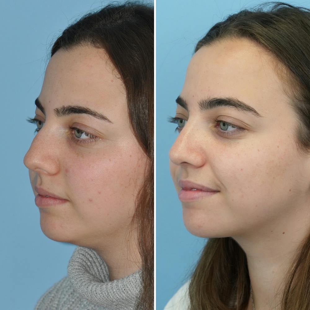 Rhinoplasty Before & After Gallery - Patient 144687105 - Image 3