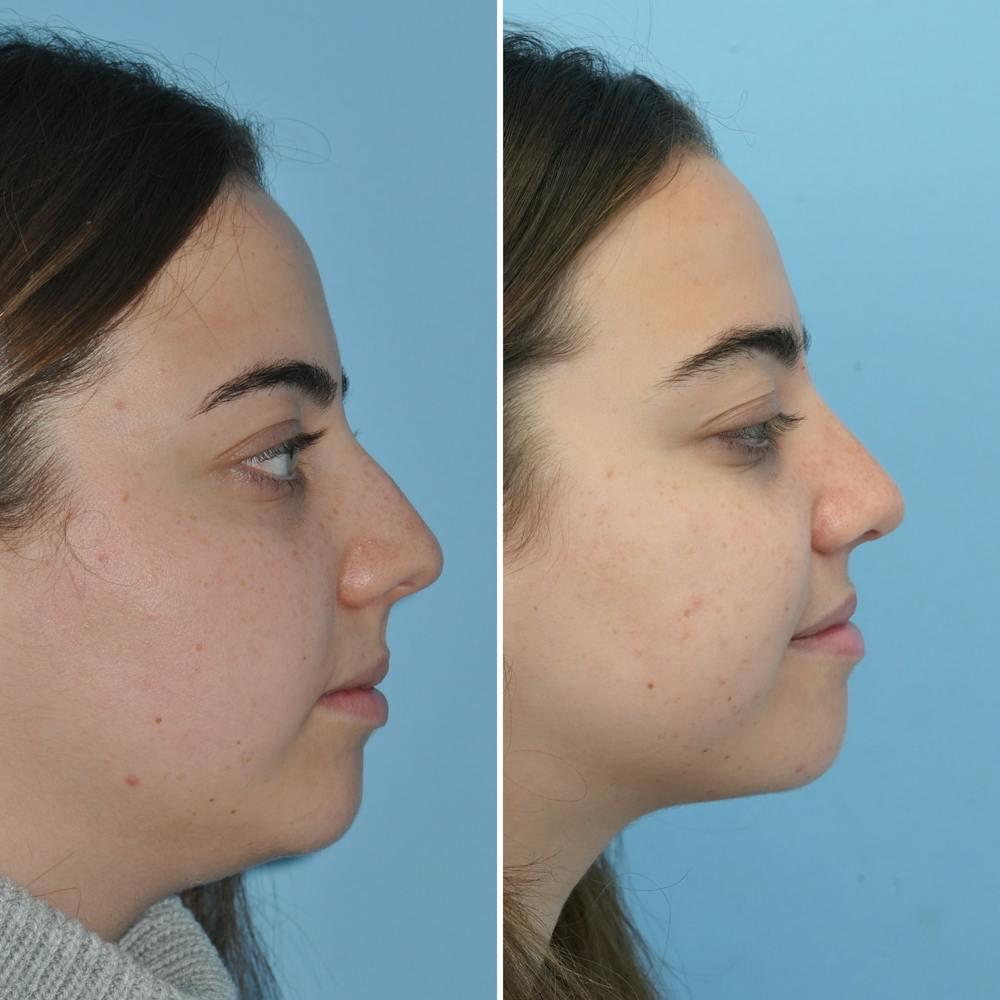 Rhinoplasty Before & After Gallery - Patient 144687105 - Image 1
