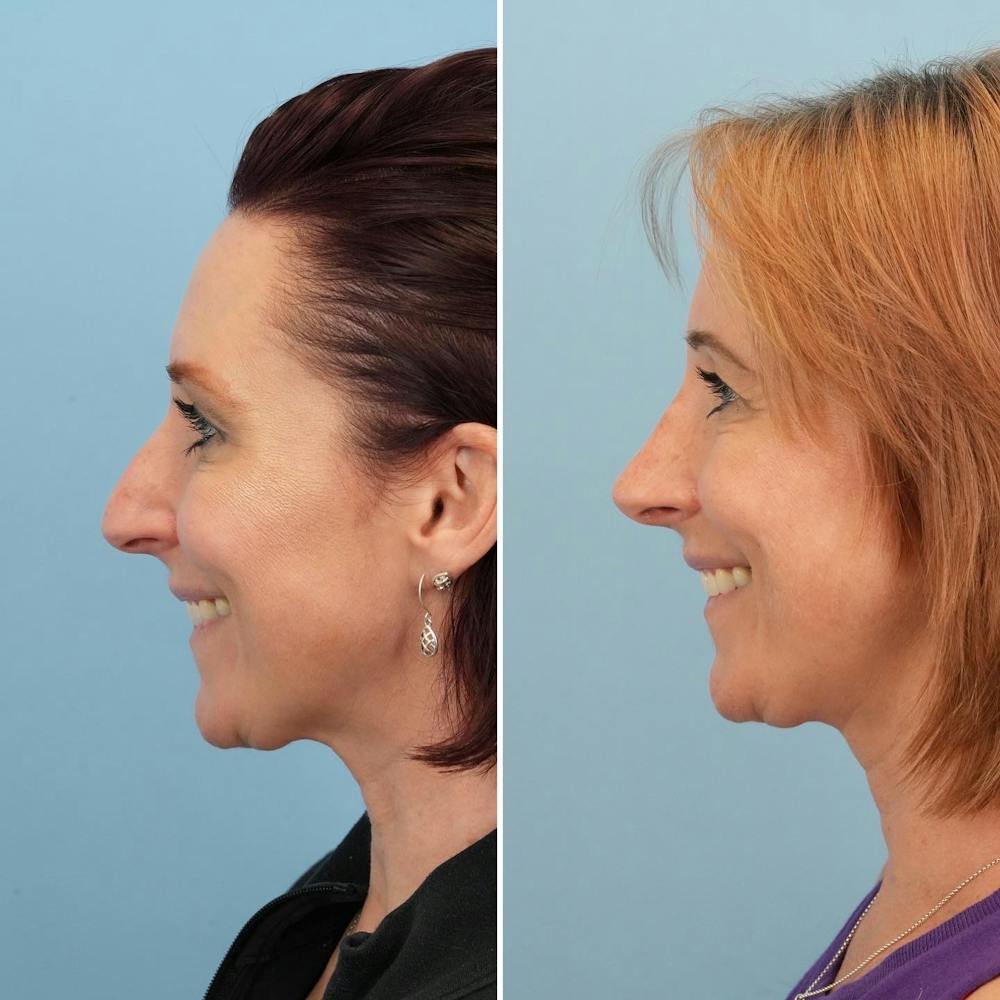 Rhinoplasty Before & After Gallery - Patient 144687101 - Image 3