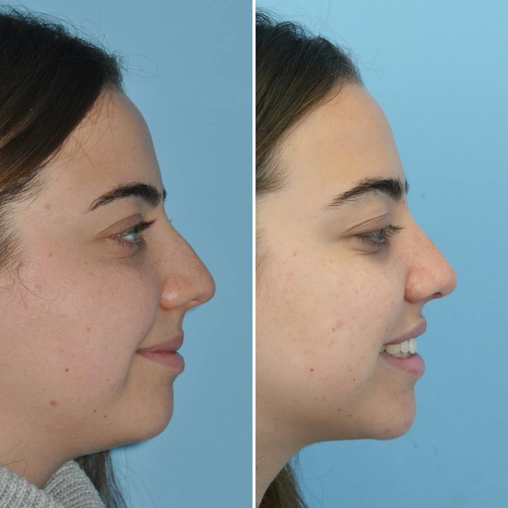 Rhinoplasty Before & After Gallery - Patient 144687105 - Image 4