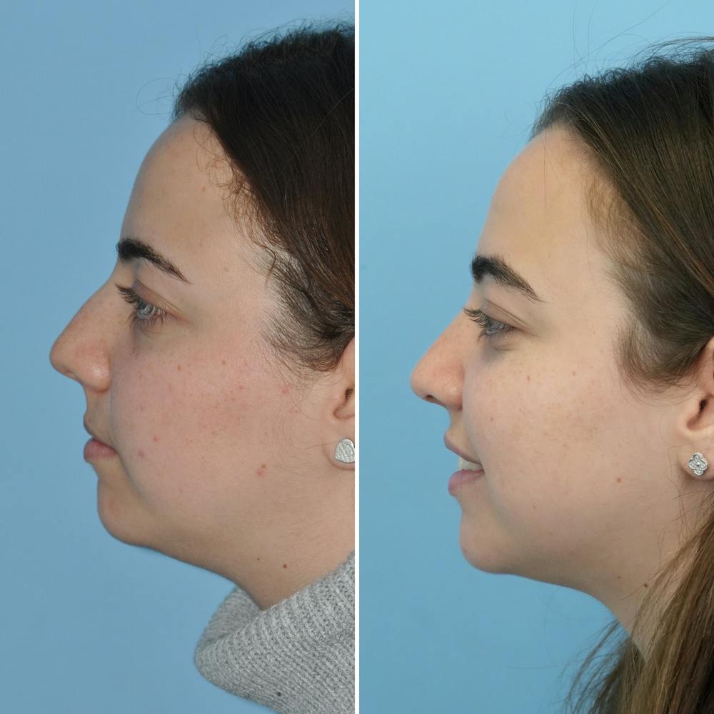 Rhinoplasty Before & After Gallery - Patient 144687105 - Image 5