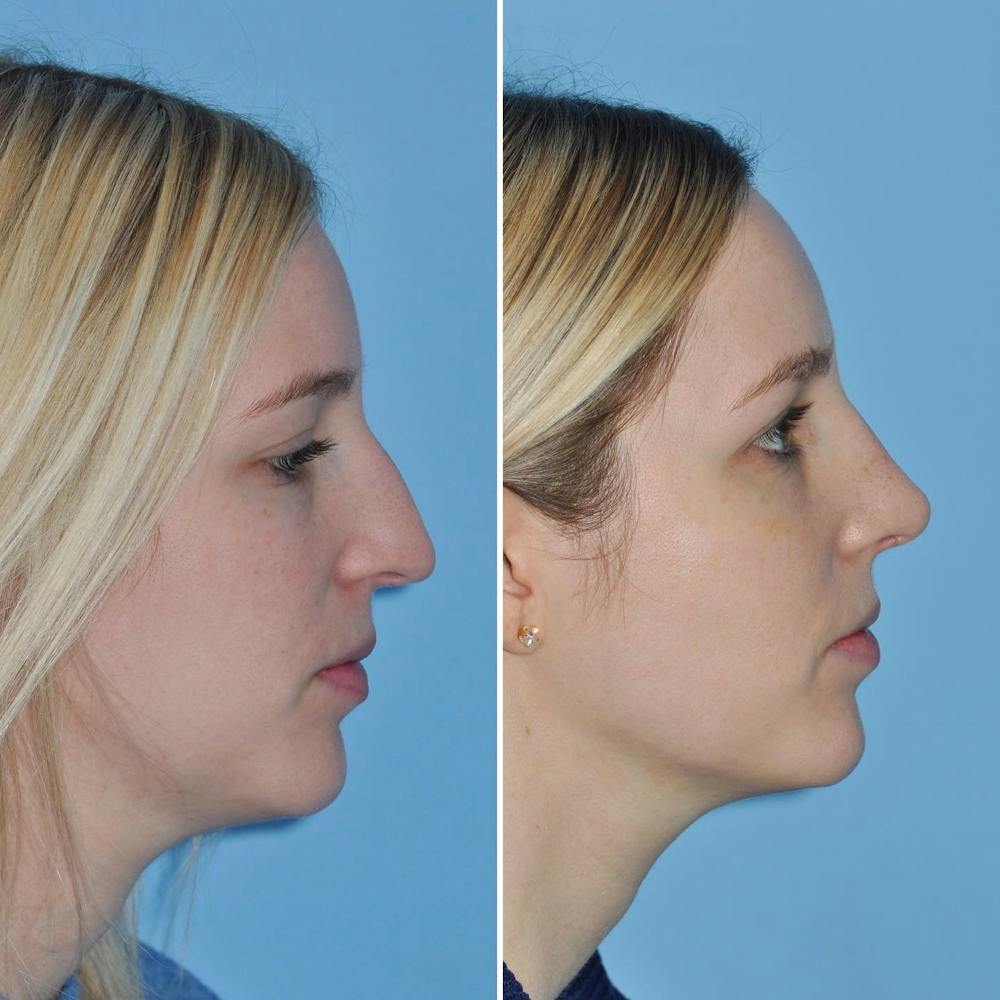 Rhinoplasty Before & After Gallery - Patient 144687122 - Image 1