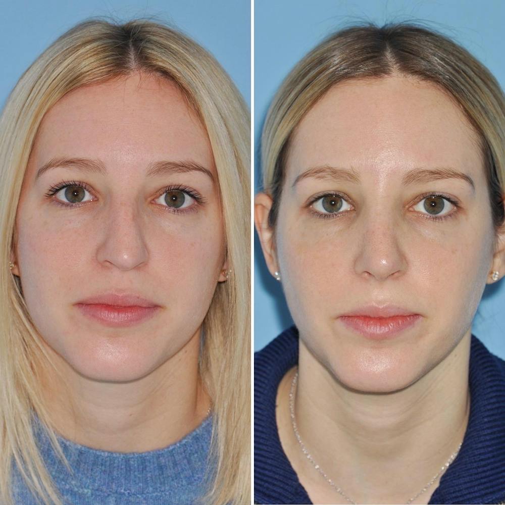 Rhinoplasty Before & After Gallery - Patient 144687122 - Image 3