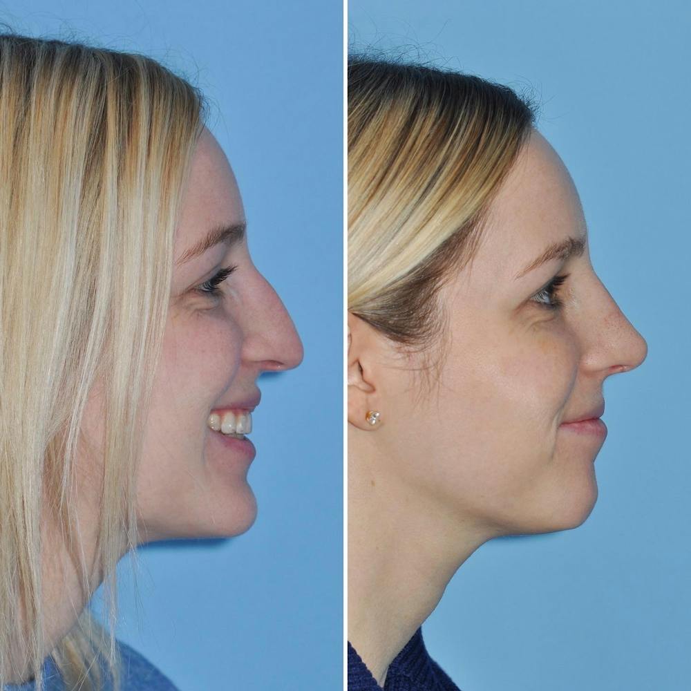 Rhinoplasty Before & After Gallery - Patient 144687122 - Image 4