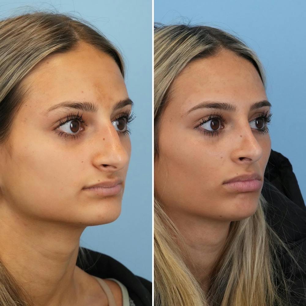 Rhinoplasty Before & After Gallery - Patient 144687100 - Image 2