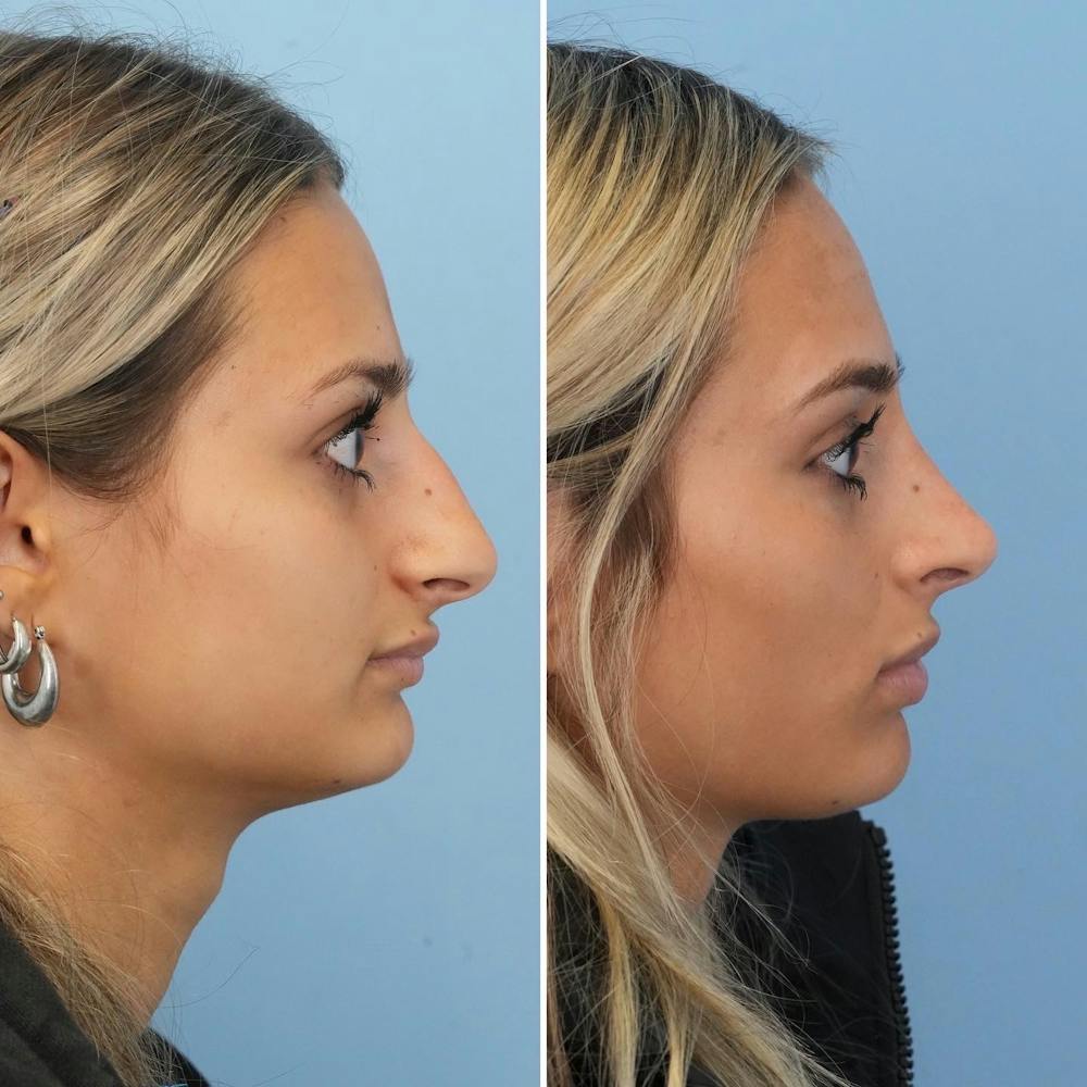 Rhinoplasty Before & After Gallery - Patient 144687100 - Image 1