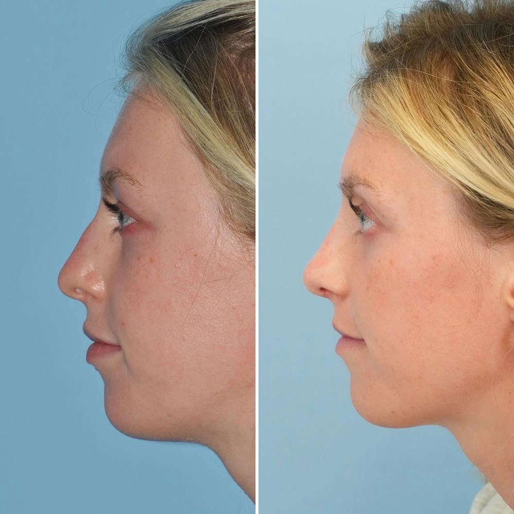Rhinoplasty Before & After Gallery - Patient 144687123 - Image 4