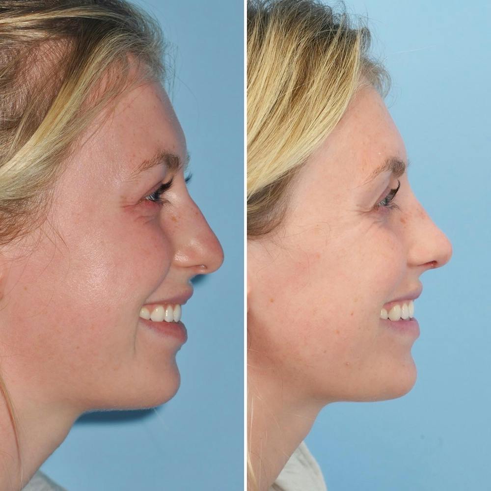 Rhinoplasty Before & After Gallery - Patient 144687123 - Image 5