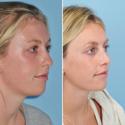 Rhinoplasty Before & After Gallery - Patient 144687123 - Image 2