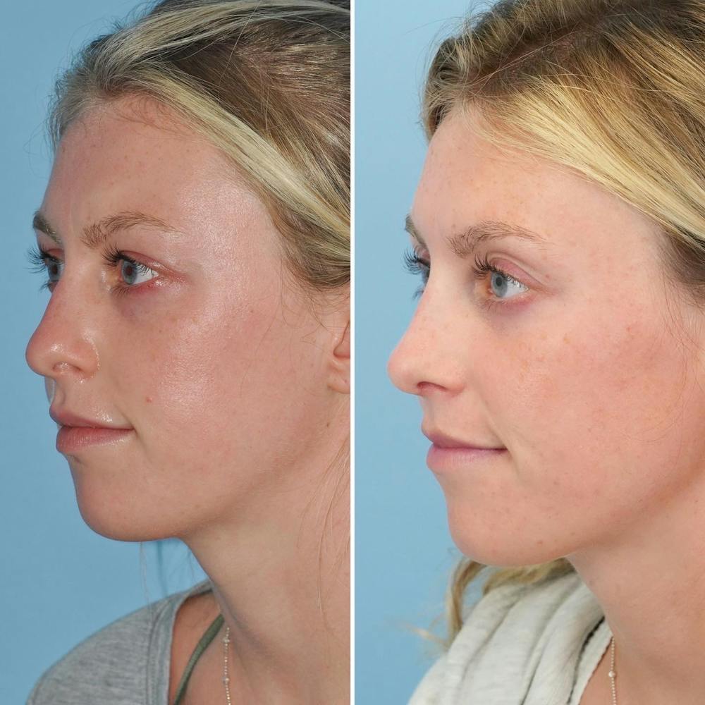 Rhinoplasty Before & After Gallery - Patient 144687123 - Image 6