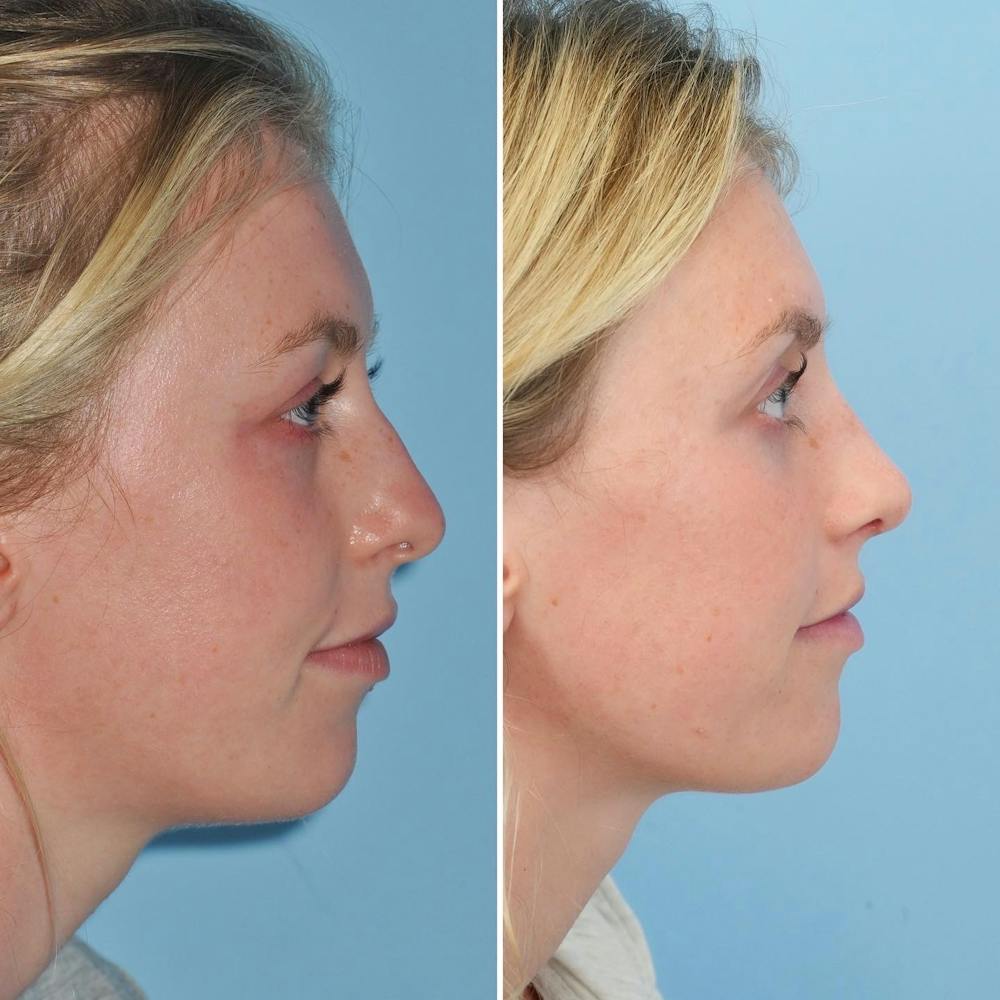 Rhinoplasty Before & After Gallery - Patient 144687123 - Image 1