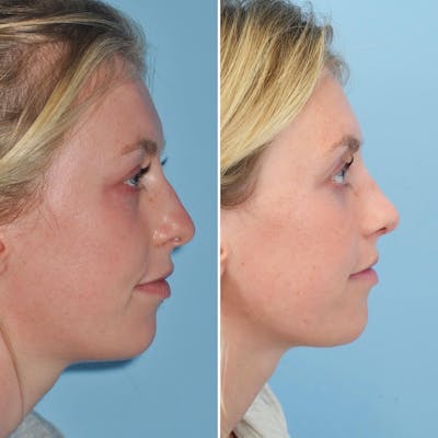 Rhinoplasty Before & After Gallery - Patient 144687123 - Image 1