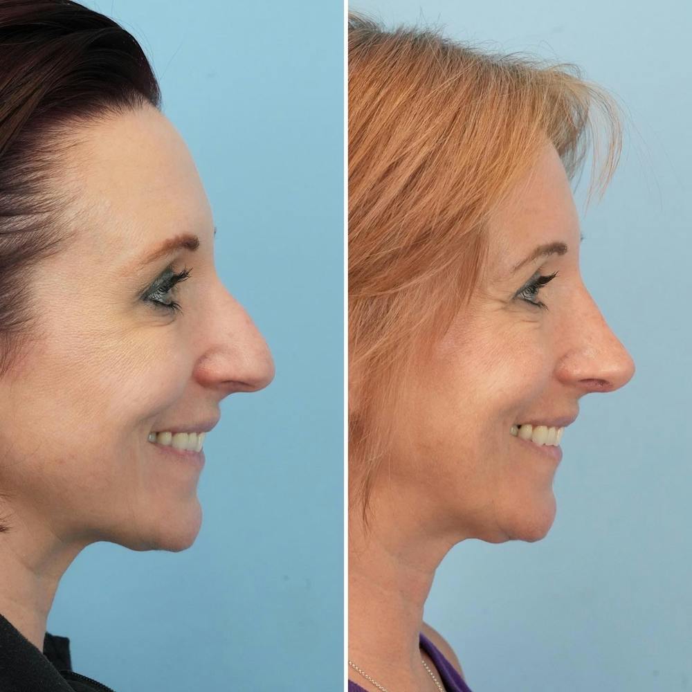 Rhinoplasty Before & After Gallery - Patient 144687101 - Image 4