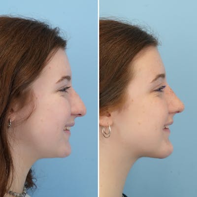 Rhinoplasty Before & After Gallery - Patient 144687129 - Image 2