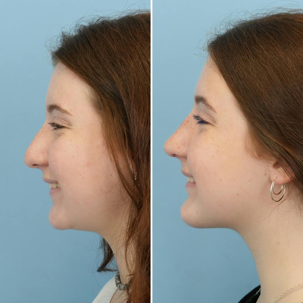 Rhinoplasty Before & After Gallery - Patient 144687129 - Image 5