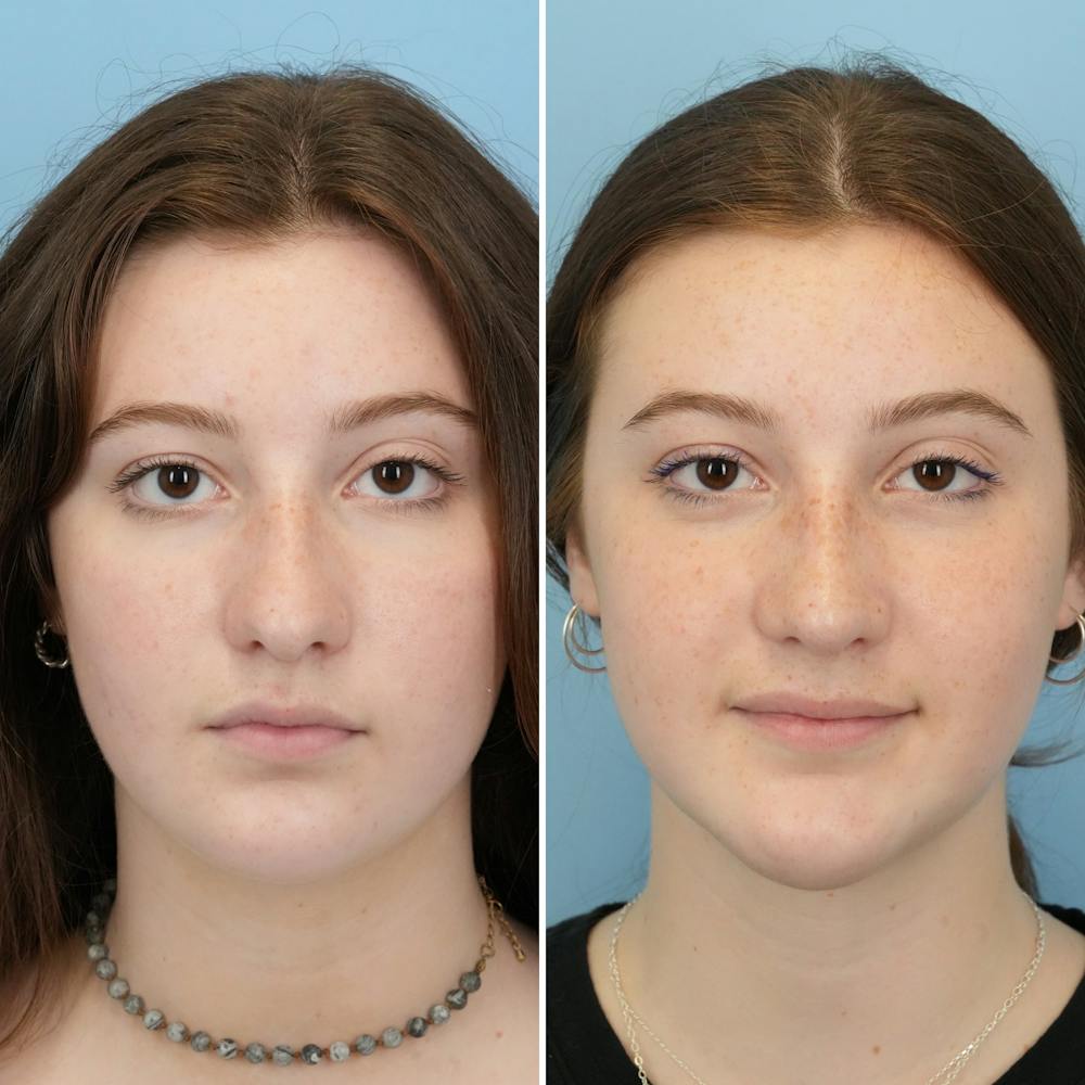 Rhinoplasty Before & After Gallery - Patient 144687129 - Image 4
