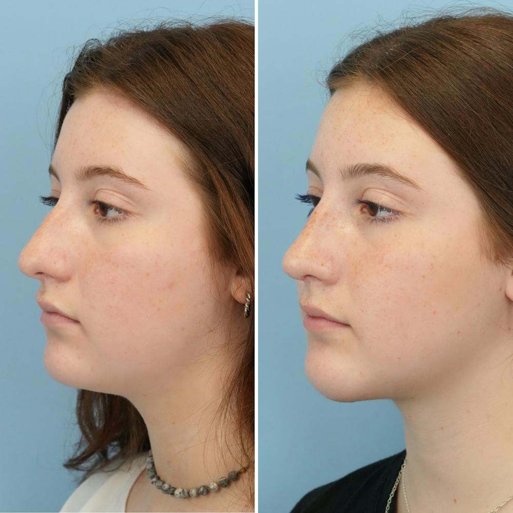 Rhinoplasty Before & After Gallery - Patient 144687129 - Image 6
