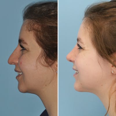 Rhinoplasty Before & After Gallery - Patient 144687139 - Image 6