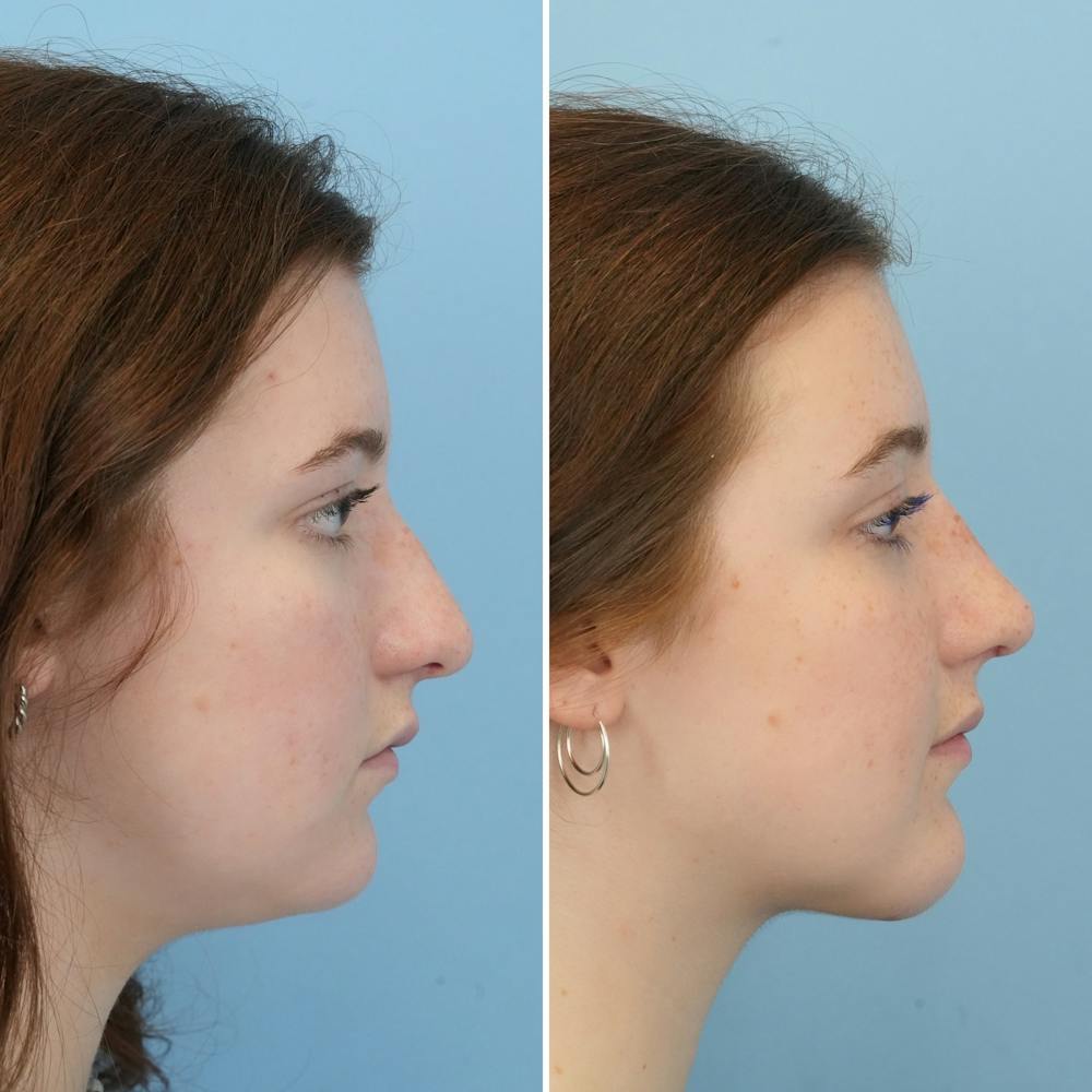 Rhinoplasty Before & After Gallery - Patient 144687129 - Image 1