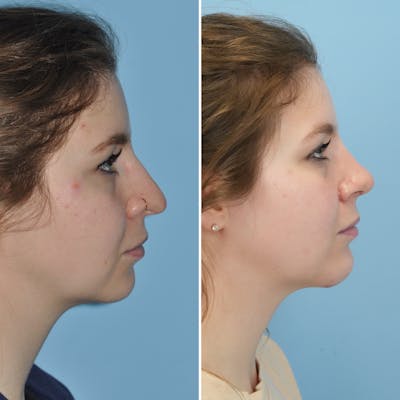 Rhinoplasty Before & After Gallery - Patient 144687139 - Image 1