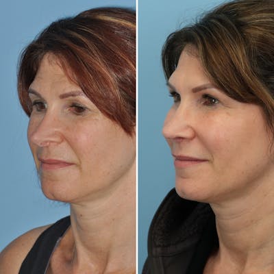 Rhinoplasty Before & After Gallery - Patient 144687137 - Image 2