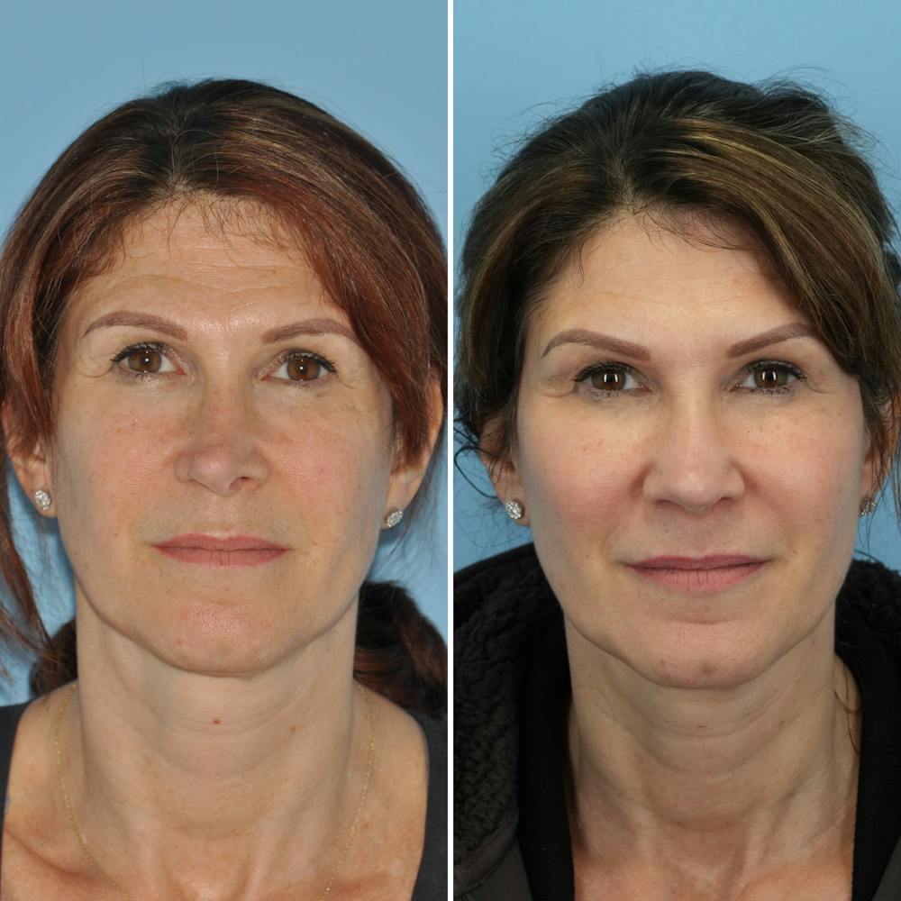 Rhinoplasty Before & After Gallery - Patient 144687137 - Image 3